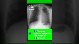 chest xray duet radiologiest radiographie thoracique [upl. by Maddy]