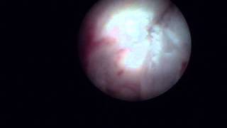 Arthroscopy of the Jaw Temporomandibular Joint TMJ  Part 1 [upl. by Elamaj32]