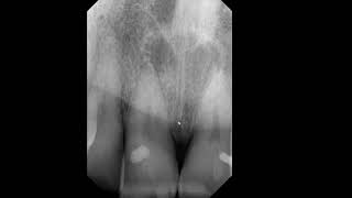 Quiz Radiolucency in anterior maxillary PA [upl. by Burrows450]