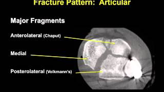 Tibial pilon fractures 1 [upl. by Llednik]