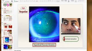 Viral keratitis [upl. by Pros438]