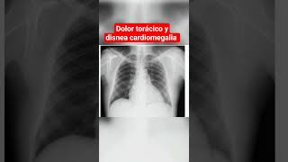 CARDIOMEGALIA DOLOR TORÁCICO Y DISNEA [upl. by Osnohpla]