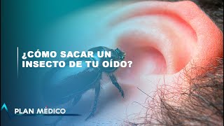 ¿Cómo sacar un insecto de tu oído  Plan Médico [upl. by Myca]