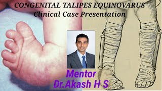 CONGENITAL TALIPES EQUINOVARUS Clinical Case Presentation [upl. by Pool]