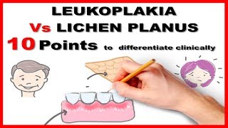 leukoplakia vs lichen planus  10 points to differentiate clinically [upl. by Leupold]