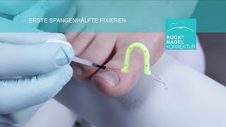 Entlastung für eingewachsene Nägel  RUCK® NAGELKORREKTUR  ORTOGRIP professional [upl. by Jennie877]