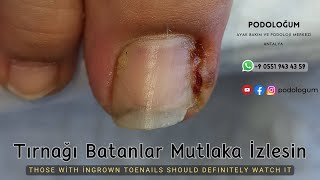 Tırnak Batması Olanlar Mutlaka İzlesinThose who have ingrown toenails should definitely watch this [upl. by Kareem560]