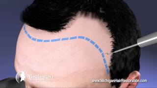 NeoGraft Michigan Hair Restoration 8444HAIRNOW [upl. by Eirahs537]