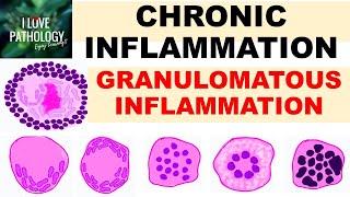 INFLAMMATION Part 9 Chronic Inflammation  GRANULOMATOUS INFLAMMATION [upl. by Delano]