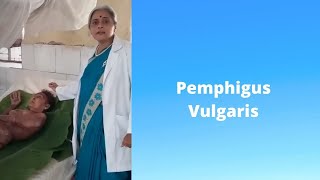 PEMPHIGUS VULGARIS Marathi pemphigus vulgaris treatment DR SMITA CHAKOTE [upl. by Adnarim]