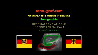 Sonographie  Atemvariable Untere Hohlvene [upl. by Desimone]