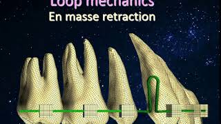 loop mechanics en masse retraction [upl. by Bandeen]