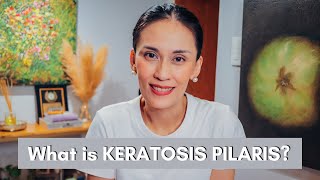 What is Keratosis Pilaris and how to Treat it  Dr Gaile RobredoVitas [upl. by Argyres66]