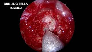 Endoscopic Transsphenoidal Hypophysectomy for Pituitary MacroadenomaDr Babu ARJSS AHER Mysore [upl. by Naillimxam]