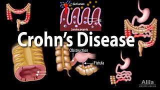 Crohns Disease Pathophysiology Symptoms Risk factors Diagnosis and Treatments Animation [upl. by Ahsiniuq216]