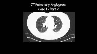 CT Pulmonary Angiogram  Case 1  Part 2 radiologist radiology angiogram pathological [upl. by Bueschel]