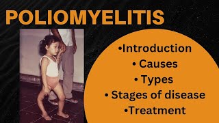 Poliomyelitis  Introduction Causes Stages of poliomyelitis diagnosis Treatment [upl. by Anelac]