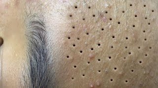 Big Cystic Acne Blackheads Extraction Blackheads amp Milia Whiteheads Removal Pimple Popping  388 [upl. by Puklich937]