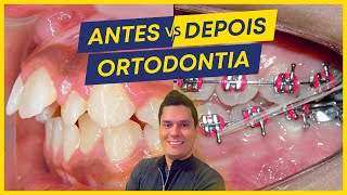 SENSACIONAL Explicando COMO TRATEI 4 CASOS EM ORTODONTIA Antes x depois [upl. by Esdnyl]