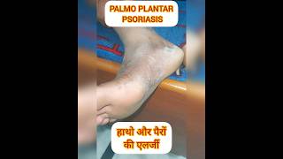 PALMOPLANTAR PSORIASIS psoriasis itching dryskin shortsfeed shortvideo shorts ytviral SHORT [upl. by Netsrik]