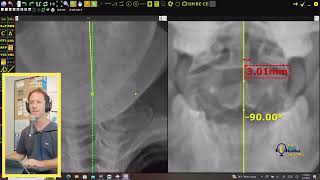 Frontal film analysis AdvO style with Dr Collins [upl. by Ursal]