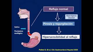 Trastornos Funcionales Esofágicos Pirosis hipersensibilidad al reflujo y dolor torácico funcional [upl. by Aspasia]