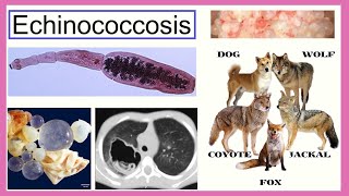 echinococcosis [upl. by Cofsky590]