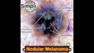 Nodular Melanoma Dermoscopy [upl. by Hedwig]