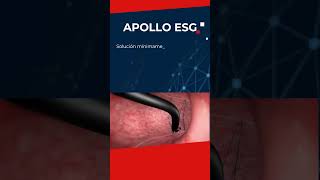 Hands ON de Apollo Endosutura [upl. by Judon]