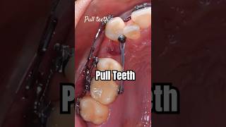 How to pull teeth when braces braces orthodontist dentist dental [upl. by Naul387]