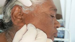 Curtain Sign  Parotid Swelling [upl. by Kiyoshi]