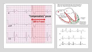 Compensatory pause occurs after Extrasystole by Prof Dr Sanhita Mukherjee [upl. by Lyrak183]