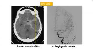 Hemorragia Subaracnoídea con Angiografia Negativa [upl. by Yatzeck]