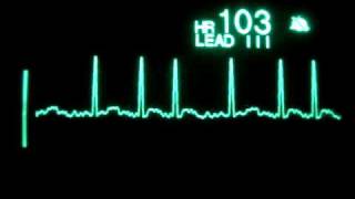 Atrial Fibrillation [upl. by Hollington]