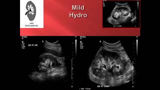 Hydronephrosis Point of Care Ultrasound [upl. by Milla652]