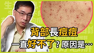 為什麼背部長痘痘，會一直治不好？怎麼治療才不會色素沉澱？治療背部痘痘的關鍵原因，醫美里長一次告訴你！ [upl. by Olympias]