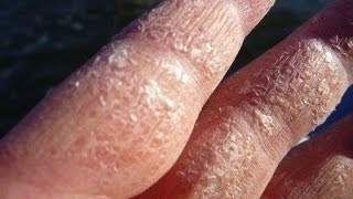 Home Remedies for Dry and Rough Hands [upl. by Arquit]