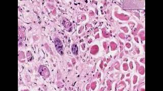 Histopathology TongueSquamous cell carcinoma [upl. by Ientirb759]