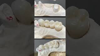 Missing teeth Restoration  Zirconium bridge shorts dentist youtubeshorts [upl. by Victor700]