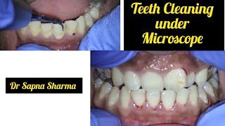 How a Dentist does Teeth Cleaning  Scaling of Teeth under Microscope [upl. by Noami]