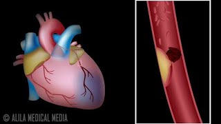 Myocardial InfarctionHeart Attack Symptoms and TreatmentCardiac Health ‎tayyebaaqeel2560 [upl. by Rednal510]