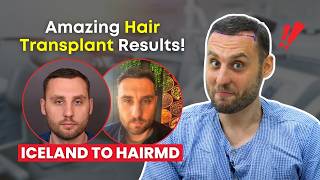 You Won’t Believe This Patient’s Results  Iceland Patient’s Hair Transplant Journey at HairMD [upl. by Imhsar69]