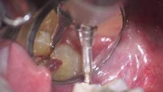 operculectomy of mx 3dr molar [upl. by Aube420]