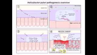 Helicobacter pylori infection and diseases [upl. by Lipscomb]