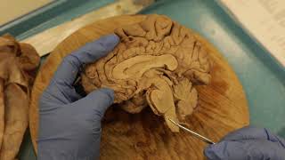 Sagittal Brain Dissection [upl. by Waers957]