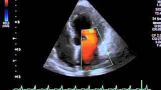 Doxorubicininduced Cardiotoxicity [upl. by Uon]