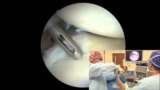 Arthroscopic Posterior Labral Repair  Randy S Schwartzberg MD [upl. by Iggem466]