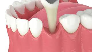 Tooth Extraction 3D Animation [upl. by Chaney709]