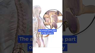 What happens in Spinal fusion surgery [upl. by Ertsevlis259]