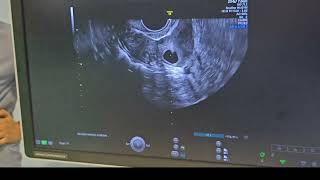 Oocyte pick up  Egg Retrieval  unedited in 6 minutes  Dr Shilpa GB [upl. by Norwood]